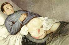 Peinture de Peter Baumgras ; soldat blessé à Deep Bottom en Virginie le 16 août 18** (par une balle de mousquet dans la jambe droite), ayant survécu à l'amputation de sa jambe droite (faite au niveau de la hanche)