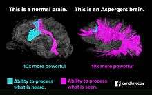 Comparaison des zones de compréhension orale et visuelle du cerveau neurotypique et du cerveau asperger.