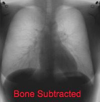 Idem, avec « soustraction » des os (combinaison linéaire de deux images à différents niveaux d'énergie, combinée selon un coefficient qui rend l'os invisible).