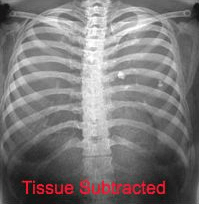 Radiographie avec « soustraction » des tissus (combinaison linéaire de deux images à différents niveaux d'énergie, combinée selon un coefficient qui rend les tissus mous invisibles).