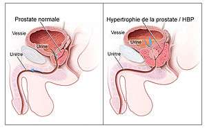 Hypertrophie bénigne de la prostate