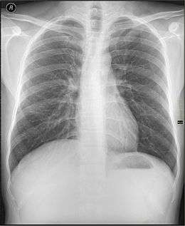 Radiographie pulmonaire numérisée.