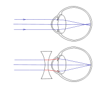 Œil myope (en haut), œil myope corrigé par une lentille divergente (en bas).