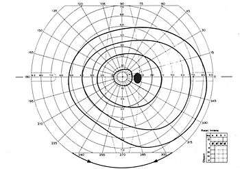 (fig. 1) Champ visuel de l’œil droit par campimétrie :
-l'angle des rayons (méridiens) avec l'horizontale est angle polaire α,-la gradation des cercles concentriques (les parallèles) indique angle visuel θ