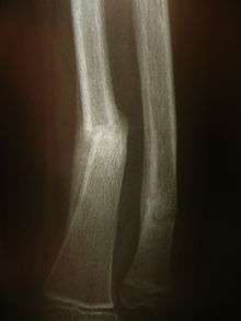 Radiographie montrant une fracture distale de l'avant bras.