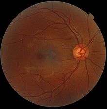 Rétinographie de l'œil: la macula est la tache sombre à gauche (la papille, origine du nerf optique, est la tache claire à droite)