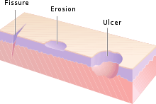 Fissures, érosions et ulcères.