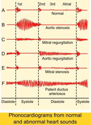 心音ruido cardíaco